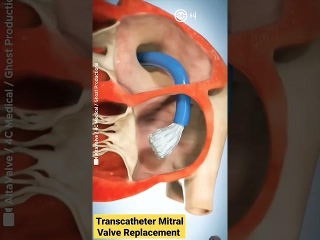 Heart surgery #medlife29 #eyes #medilife #healthcarejobs #motivation #medicalstudentlife #doctor