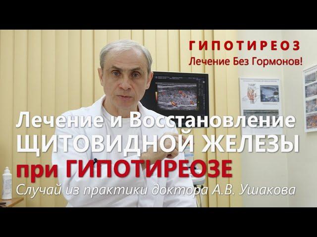 Гипотиреоз: Лечение без гормонов Щитовидной железы. Пример случая из практики || Доктор Ушаков