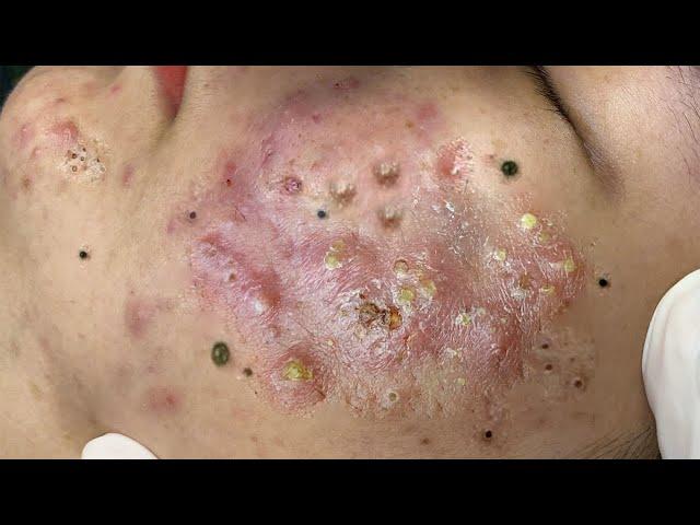 Big Cystic Acne Blackheads Extraction Blackheads & Milia, Whiteheads Removal Pimple Popping # 9202