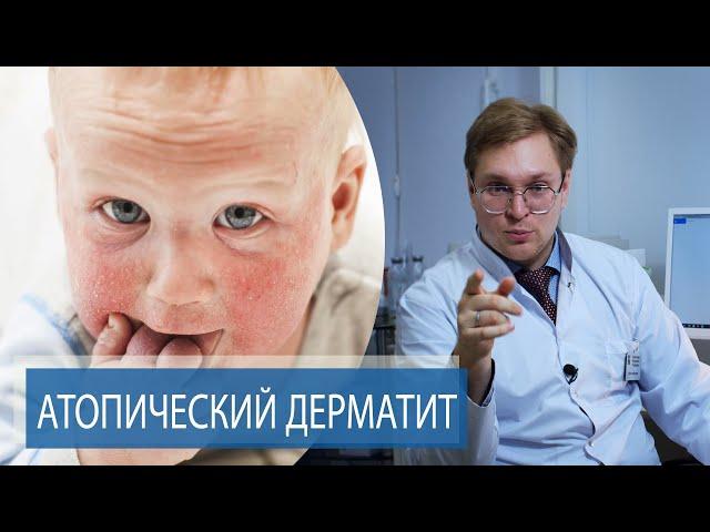 АТОПИЧЕСКИЙ ДЕРМАТИТ | Как лечить ДИАТЕЗ