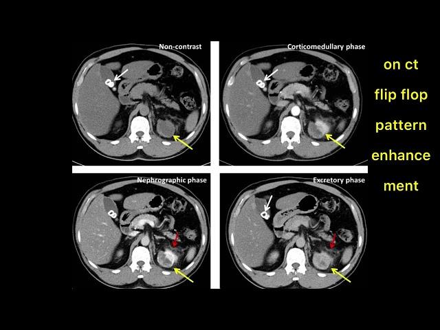 ONCOCYTOMA ON EACH MODALITY