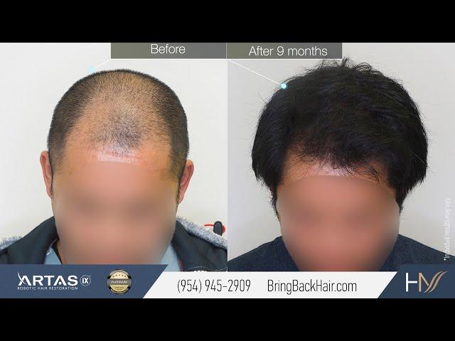 Hair By Dr. Max, Restoration Center: Before and After Results with ARTAS iX Hair Transplant