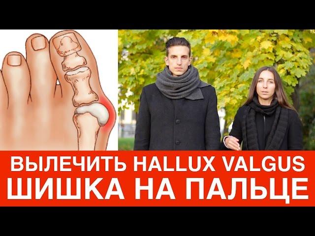 Шишка на большом пальце ноги.  Hallux Valgus.  Как вылечить халюкс вальгус