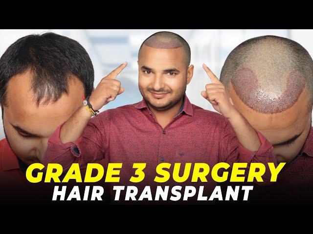 Hair Transplant in Alwar | Best Results & Cost of Hair Transplant in Alwar