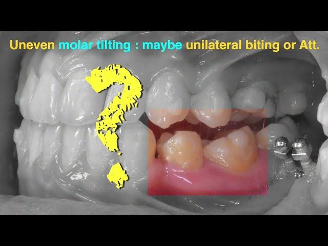 Treatment of Class III Malocclusion with Clear Aligner｜【Chris Chang Ortho】CC711