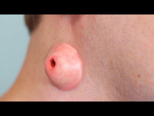 HUGE CYST ON NECK!