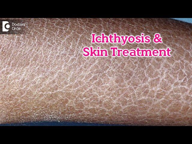 What is Ichthyosis? How to Treat my Skin?| Fish like scales On Skin-Dr.Rasya Dixit | Doctors' Circle