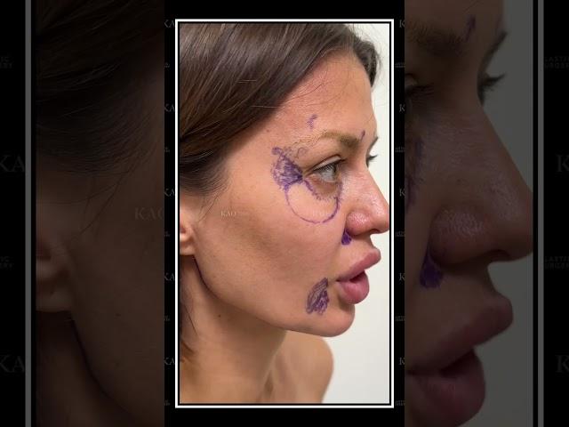 Victoria Bonya Ponytail Lift - Day of Facelift #ponytaillift #victoriabonya