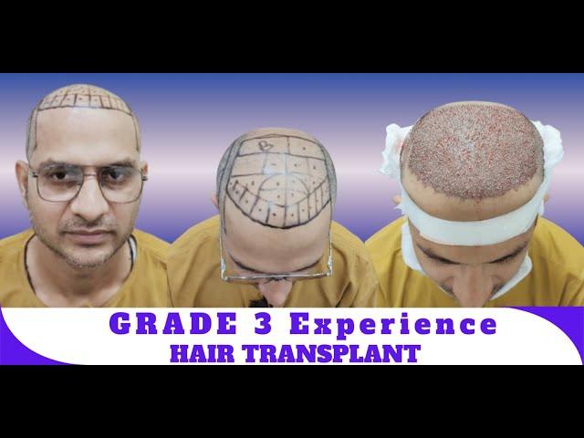 Hair Transplant in indore | Best Results & Cost of Hair Transplant in indore