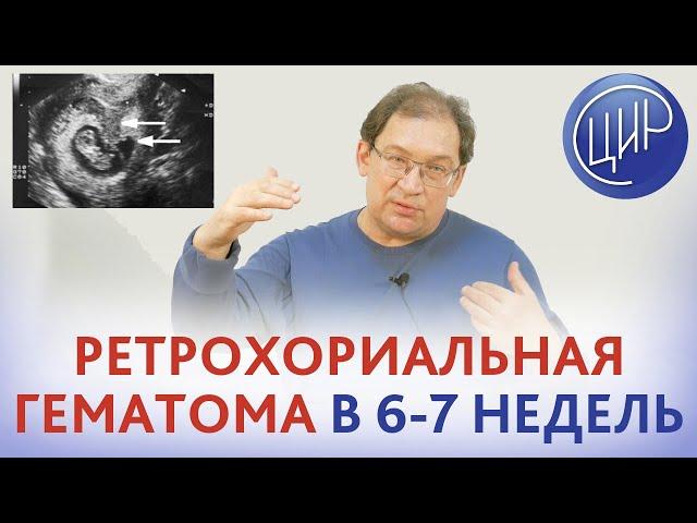 Ретрохориальная гематома в 6-7 недель, гипертонус матки и низкая плацента - опасно ли это? Гузов И.И