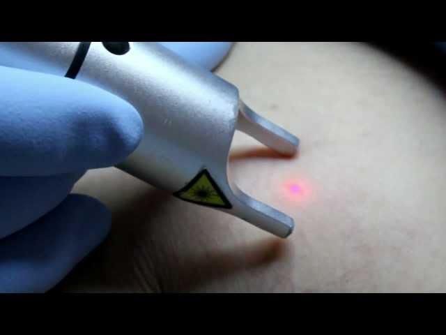 Arañitas venosas con laser lumiia