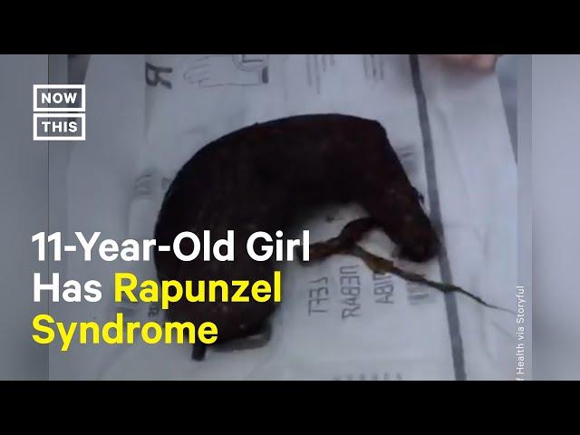 Doctors Remove 6+ Pounds of Hair from Girl’s Stomach