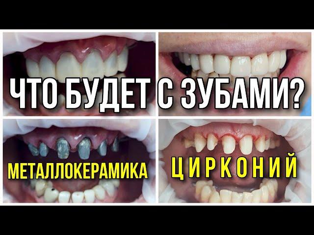 Что выбрать, металлокерамику или цирконий? Имплантация зубов.