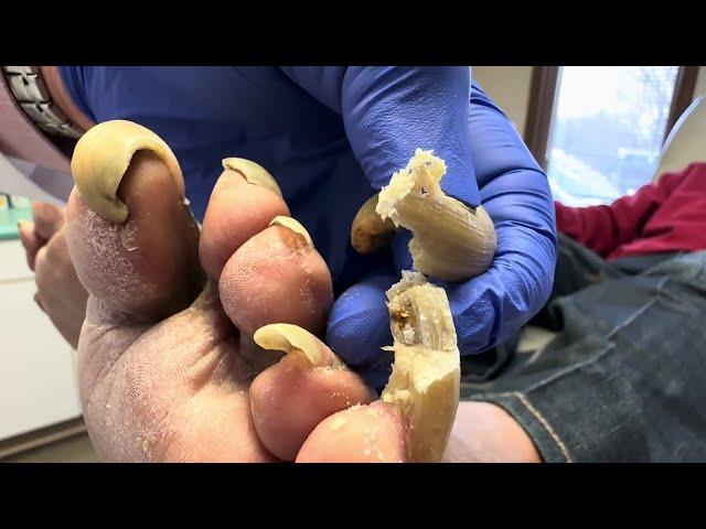 Unbelievable!  Toenails so long and painful that patient cannot walk!