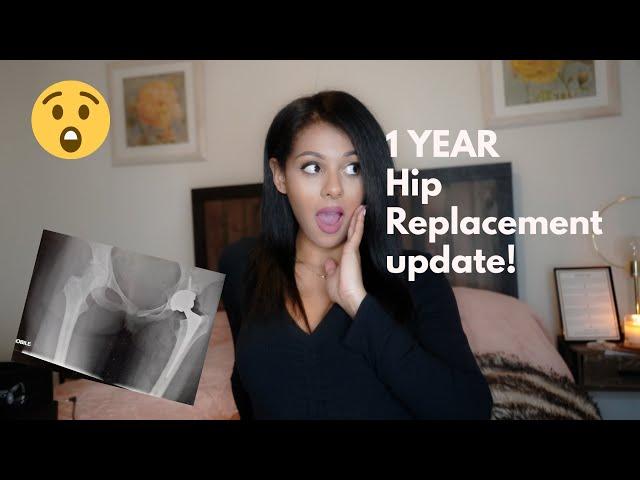 Major Surgery | 1 year Hip Replacement Update