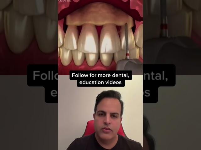Shaving the jawbone for this!#jaw#Dentistry #Gum #Shorts