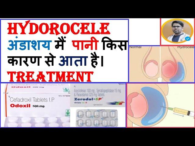 HYDROCELE के कारण/लक्षण/इलाज/TREATMENT OF HYDROCELE/HYDROCELE की दवाई/BEST MEDICINE FOR HYDROCELE