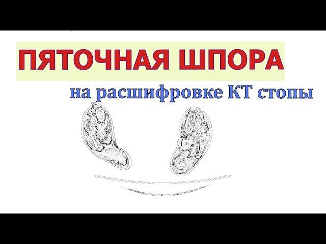 Как выглядит ПЯТОЧНАЯ ШПОРА на расшифровке КТ стопы