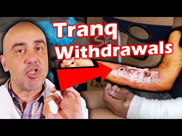 Tranq Dope Withdrawal Symptoms: The Dangerous Truth