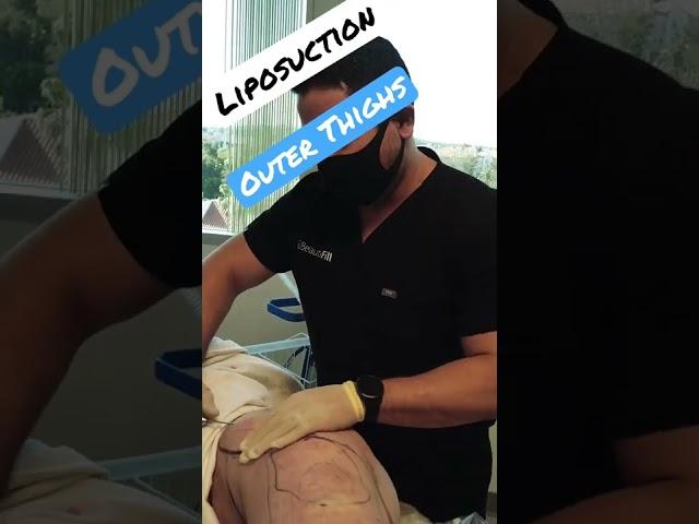 Liposuction Outer Thighs using Beautifill | Luminary MD