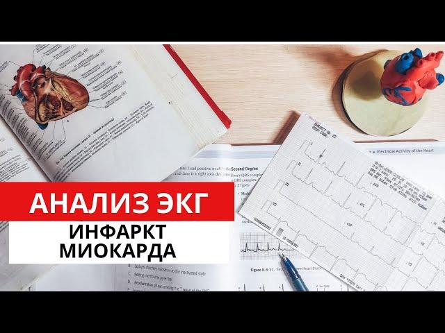 Инфаркт Миокарда. ЭКГ диагностика. Часть 1.