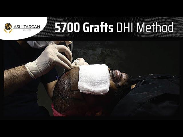 5700 Grafts DHI Hair Transplant / DHI Hair Technique in Turkey