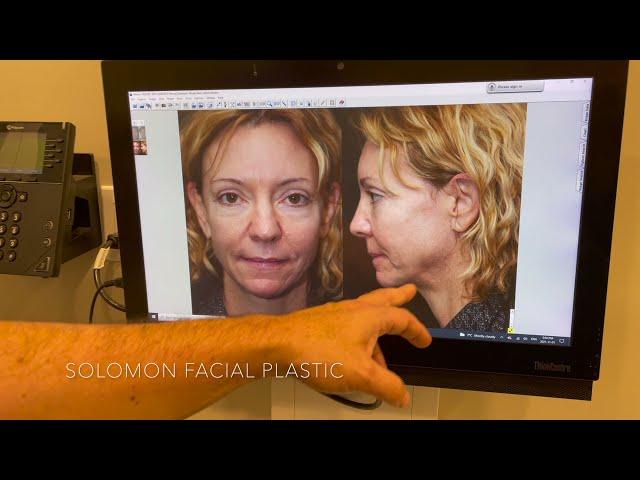 Facelift Surgery Before and After Results by Dr. Philip Solomon in Toronto