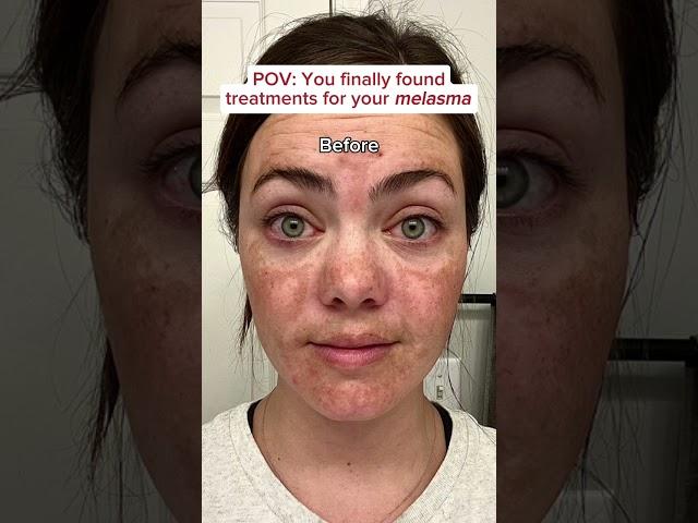 The BEST way to fade melasma? Pair together The Spot Cream and The Spot Pill  #musely #melasma