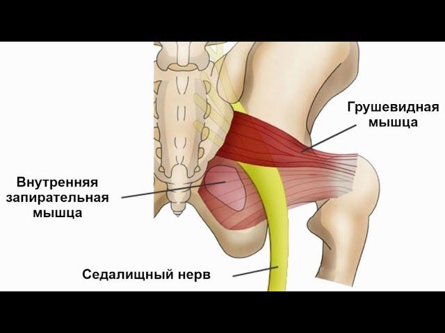 Синдром грушевидной мышцы. Малиновская