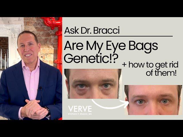 Are Eye-bags Genetic? | Ask Dr. Bracci