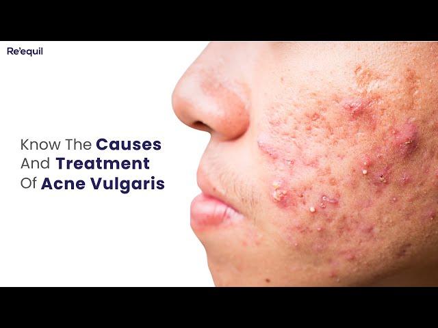 Causes And Treatment Of Acne Vulgaris