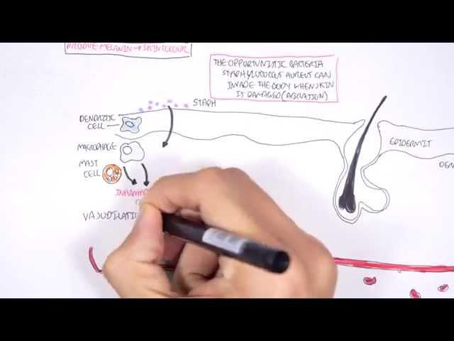 Microbiology - Staphylococcus Aureus and Skin Abscess