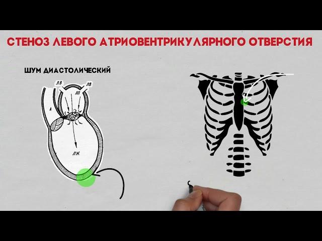 Характеристика шумов при пороках сердца