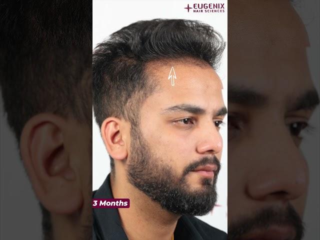 YouTuber Elvish Yadav Before & After Hair Transplant Results Update After 3 Months