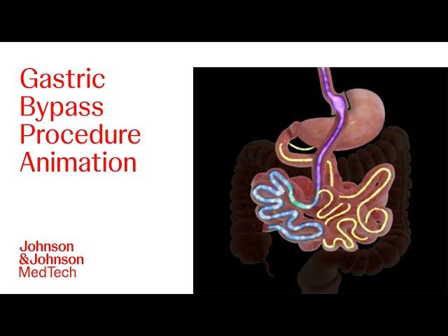 Gastric Bypass Procedure Animation | J&J MedTech