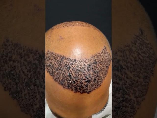 Hair transplant surgery