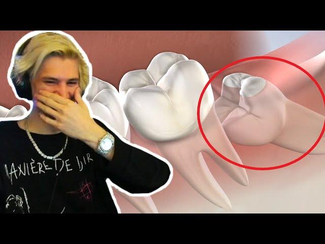 xQc Reacts to Wisdom Teeth Removal Surgery