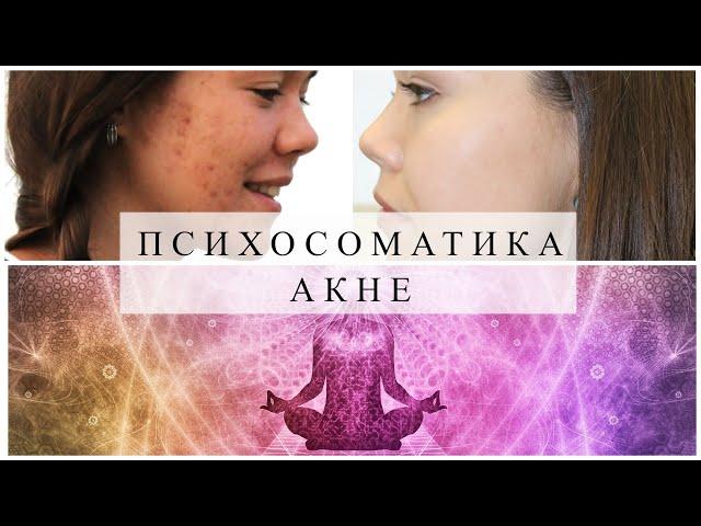 ПСИХОСОМАТИКА АКНЕ. Как избавиться от прыщей? #акне #проблемнаякожа #прыщи