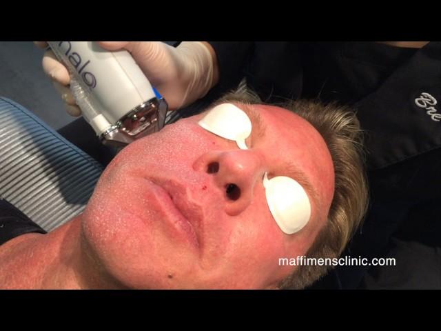 Maffi Clinics: Halo Treatment for Men