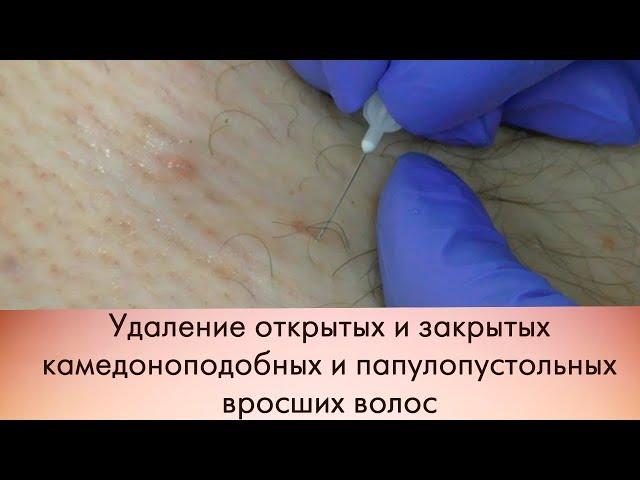 Удаление открытых и закрытых камедоноподобных и папулопустольных вросших волос