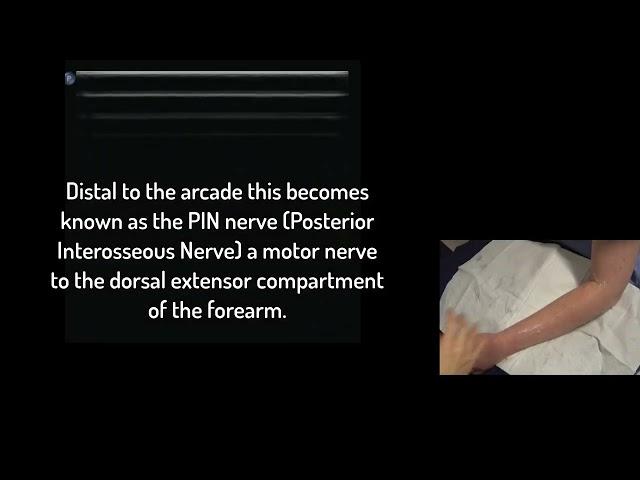 Deep br. Radial Nerve Ultrasound (PIN - Posterior Interosseous Nerve)  Supinator Arcade part 1.