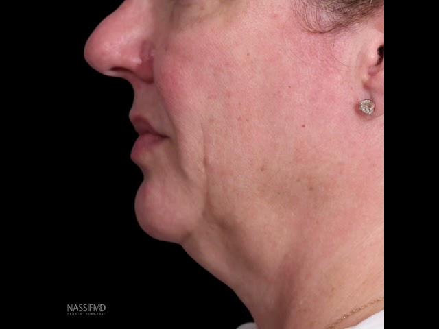 Deep Plane Facelift Results with Dr. Paul Nassif - 6 Months Post-Op