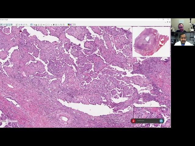 Sanjay Mukhopadhyay and Matt Cecchini Thoracic Survival Guide video