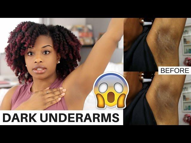 How To Lighten Dark Underarms Naturally and Fast | BEFORE AND AFTER RESULTS! | journeytowaistlength