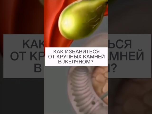 Как избавиться от крупных камней в желчном?