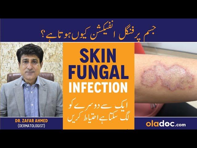 Jism Pe Fungus Ka Ilaj - Skin Fungal Infection Treatment - Ringworm On Skin - Dad Khad Ka Ilaj