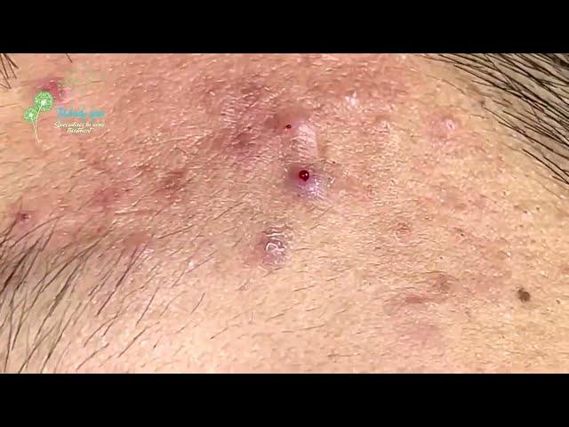 Huong Da Nang Acne Treatment (#375  )