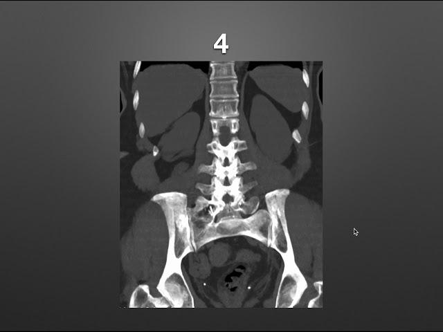 Normal variants in Imaging