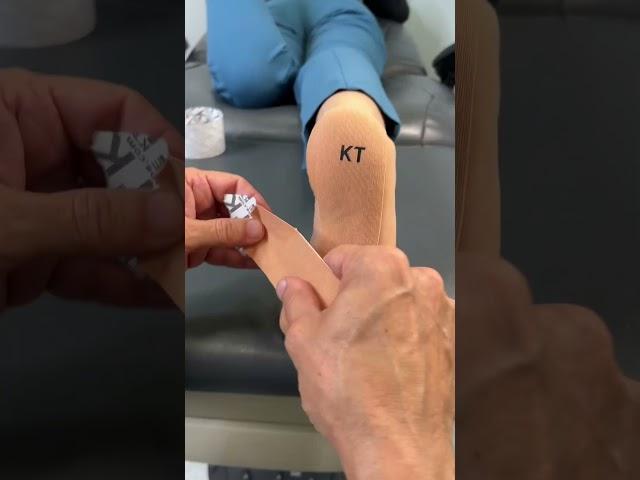 Plantar Fasciitis Treatment! WOW.