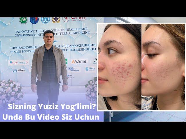 Ugri | Yog’li yuzni Davolash